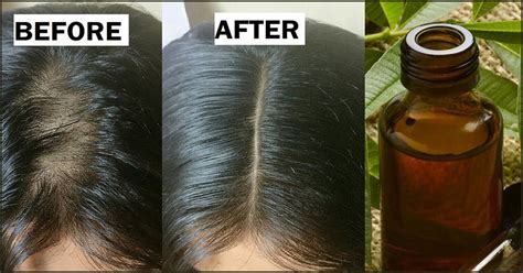 Can Hair Color Kill Lice And Nits | Makeuptutor.org