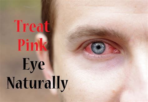 How To Treat Pink Eye