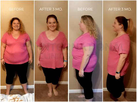 Gastric Sleeve Before And After Months Results Pictures Videos