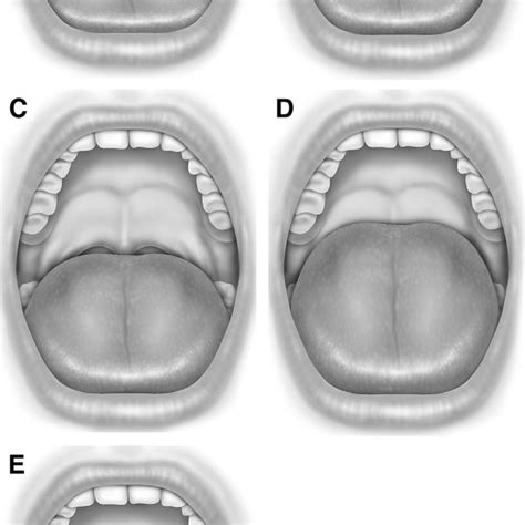 Pdf Interexaminer Agreement Of Friedman Tongue Positions For Staging