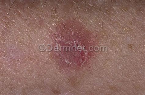 What Is Skin Keratosis Dorothee Padraig South West Skin Health Care