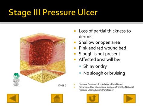 Stage 3 Ulcer Ppt Pressure Ulcers In The Critically Ill Patient Stage 3 Is Defined As