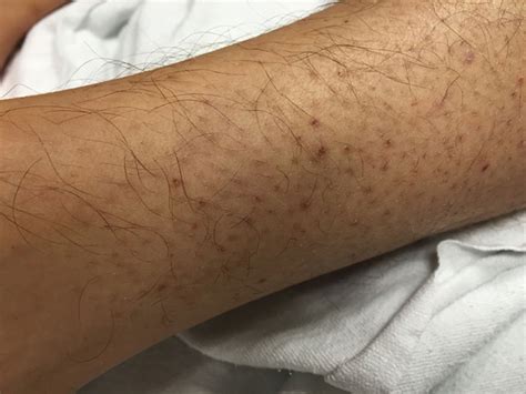 14 Year Old Male With History Of All Presents With Perifollicular Rash
