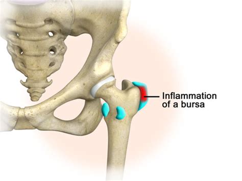 Hip Pain Singapore Sports And Orthopaedic Clinic