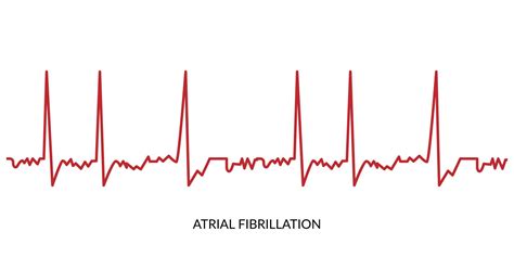 ecg batimento cardiaco linha eletrocardiograma vetor ilustração atrial fibrilação