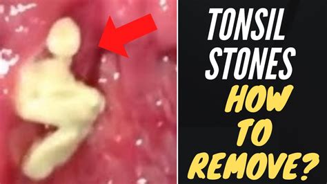 Tonsil Stones Removal At Home Tonsil Stone Removal Causes And