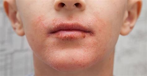 Dry Skin Types Symptoms Causes And Treatment