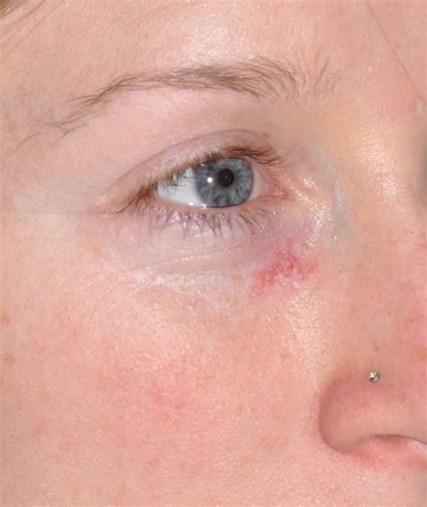 Facial Skin Cancer Seattle Face And Skin