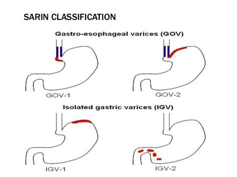 Oesophageal And Gastric Varices Classifications