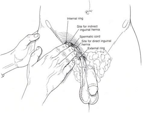 Often groin strain occurs in the area of inguinal ligament. How to find my inguinal canal - Quora