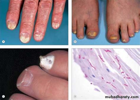 Dermatophyte Infection Pptx D Alaa Muhadharaty