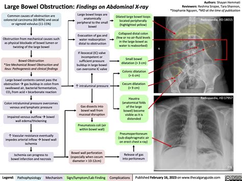 Large Bowel Obstruction Findings On Abdominal X Ray Calgary Guide