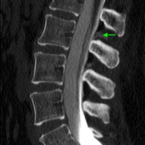 Ct Myelogram Of The Lumbar Spine Revealing Extradural Contrast