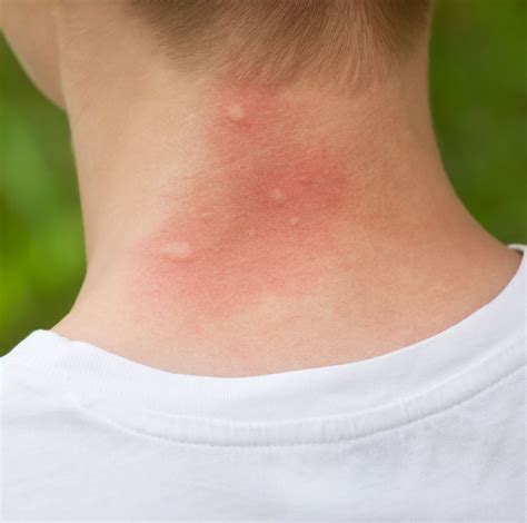 Do You Have A Mosquito Bite Allergy The Most Common Reactions