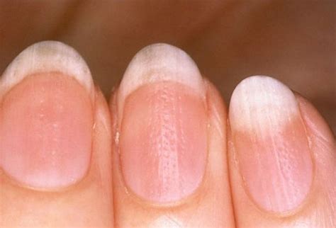 5 Most Common Fingernail Disorders Nail Health Health Signs