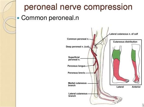 Peroneal Nerve Palsy Icd 10