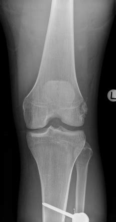 Avulsion Fracture Of Lateral Collateral Ligament Femoral Attachment Radiology Case