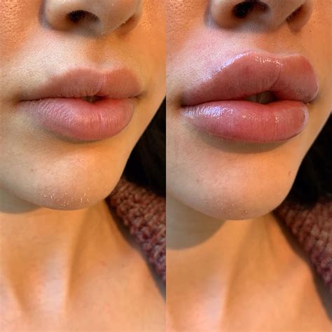 Kissable Lips Kissable Lips Botox Lips Lip Fillers