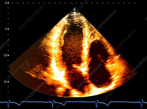 Normal Heart Ultrasound Scan Stock Image C048 0784 Science Photo