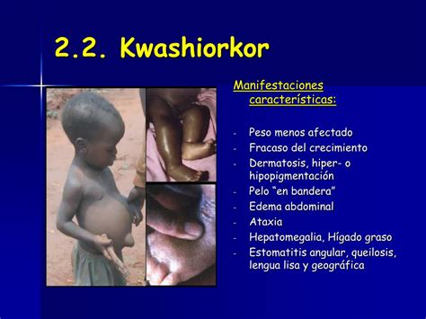 Ppt Problemas Nutricionales I Marasmo Y Kwashiorkor Powerpoint
