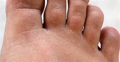 How To Decrease The Swelling With An Infected Toe Livestrongcom