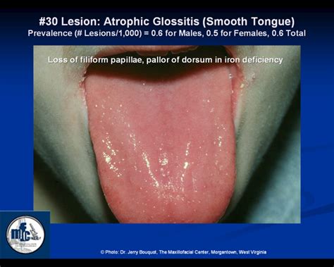 Smooth Tongue Anemia