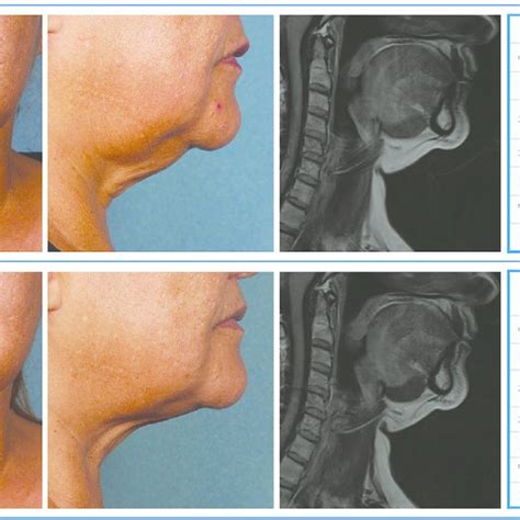 Representative Images Of The Aspect Of The Submental Fat Of Patients