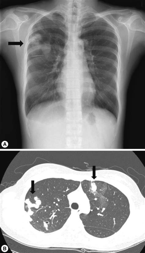Figure 1a Pulmonary Paragonimiasis Case Mimicking Metastatic Pulmonary