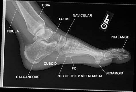 Pin By 👑shayma👑 On Bones Radiology Student Medical Ultrasound Foot