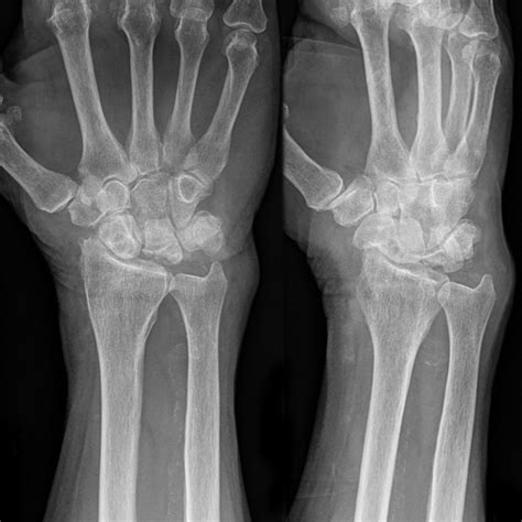 Kienbocks Disease Melbourne Hand Surgery