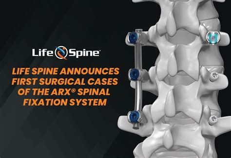 Life Spine Announces First Surgical Cases Of The Arx Spinal Fixation