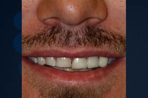 Before And After Photos Bluegrass Dentistry Lexington Ky