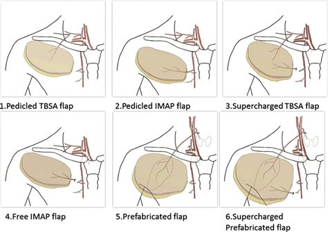 Different Flap Techniques Of The Anterior Chest Area Tbsa Thoracic