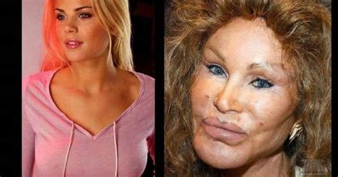 The Consequences Of Plastic Surgery Mishaps Right On Their Faces With