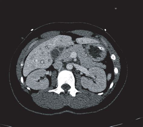 Ct Scan Showing A Normal Pancreas Download Scientific Diagram