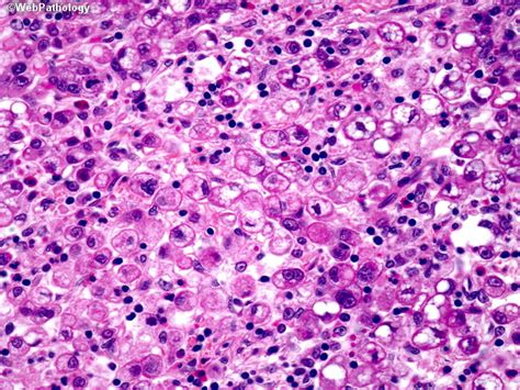 Adenocarcinoma Signet Ring Adenocarcinoma