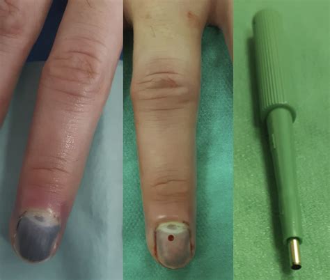 A Simple Painless Technique To Drain Subungual Hematoma Journal Of