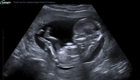 Everyones 13 Week Ultrasound Pics March 2017 Babycenter Canada