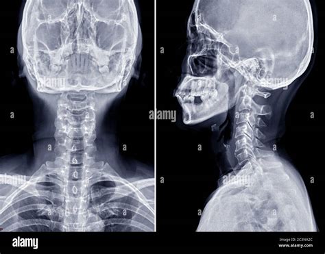 X Ray C Spine Or X Ray Image Of Cervical Spine Ap And Lateral View For