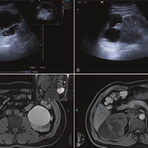 A Ultrasound Showing A Hybrid Echo Cystic Solid Mass In The Left