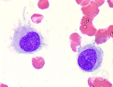 Reactive Histiocytes In The Peripheral Blood 2