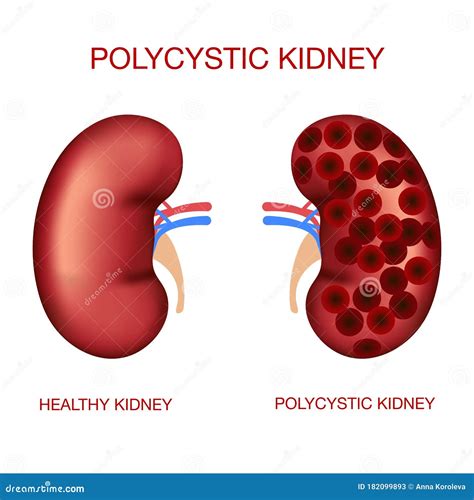 Polycystic Kidney Diseasenormal And Polycystic Kidneysrealistic