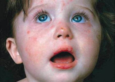 Scarlatina La Copii Simptome Cauze Tratament Si Prevenire Lylaro