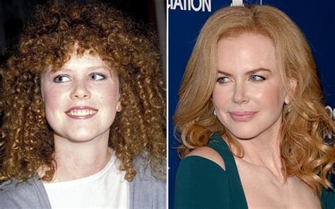 Nicole Kidman Before And After Plastic Surgery