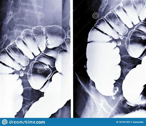 Barium Enema Image Or X Ray Image Of Large Intestine Stock Image