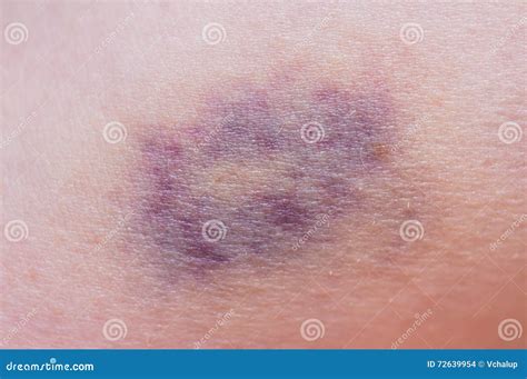 Macro Shot Of Purple Bruise On Skin Stock Photo Image Of Subcutaneous