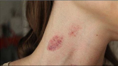 How To Properly Remove A Hickey In Minutes Best Tutorial To Remove A