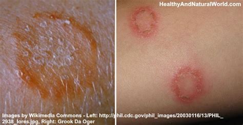 How To Get Rid Of Ringworm The Best Home Remedies Research Based