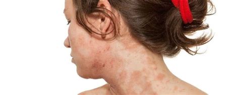 Atopowe zapalenie skóry to choroba uwarunkowana genetycznie Główne