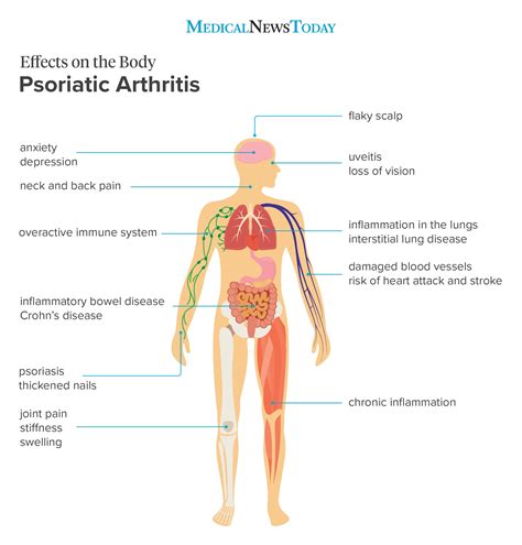 How Does Psoriatic Arthritis Affect The Body Psoriatic Arthritis Psoriatic Arthritis Symptoms